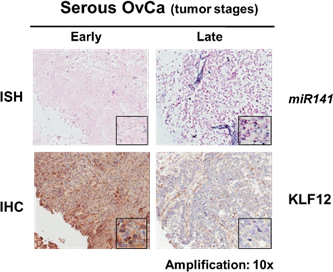  The reciprocal expressions of miR-141 and KLF12 were shown by in situ hybridization (ISH) and immunohistochemical (IHC) analyses in early and advanced serous subtype ovarian cancers.