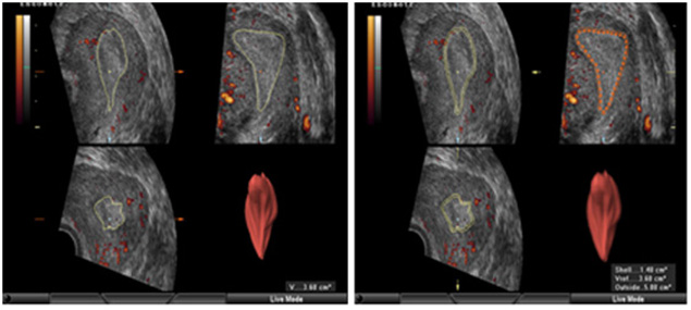 Endometrial and subendometrial blood flow determined by three-dimensional power Doppler ultrasound and shell technique